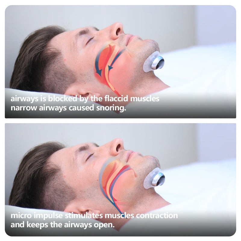 Smart Anti-Snoring Device – Electronic Muscle Stimulator